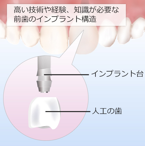 高い技術や経験、知識が必要な前歯のインプラント構造