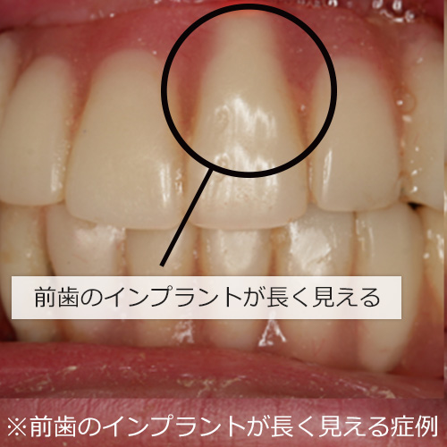※前歯のインプラントが長く見える症例
