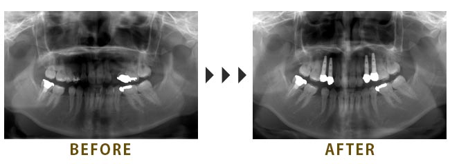 左上4番・5番(小臼歯)に4本のインプラントを埋入