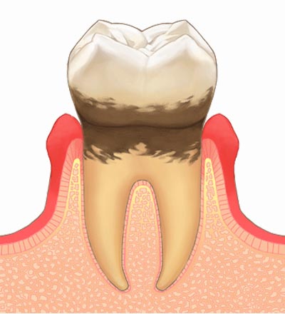 中等度歯周病のの状態の歯と歯肉の状態