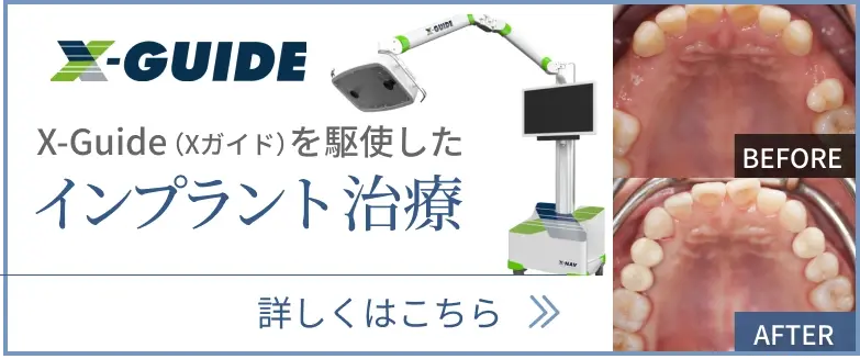 X-Guide(Xガイド)を駆使したインプラント治療